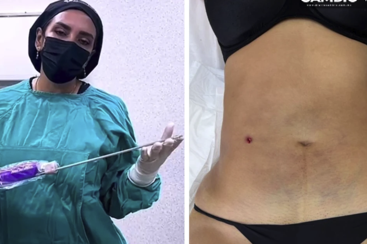 “Sexual Chips” and 14,000 Peso Lipo: Inside the Detox Clinic Where Blanca Adriana Disappeared
